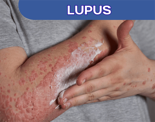 sop subarashi untuk lupus