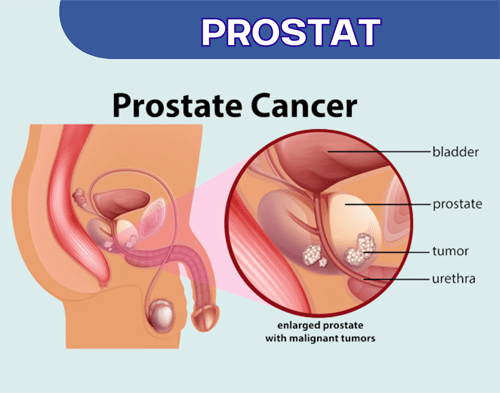 sop subarashi untuk prostat